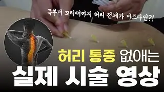 목부터 허리까지 전체가 다 아플 때 하는 시술 영상