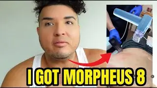 Morpheus 8 $4,500 PROCEDURE DOES IT WORK?  ISLAND DRIP & MED SPA