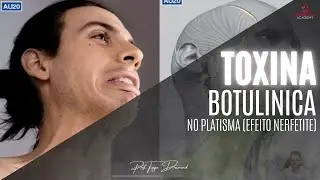Toxina botulínica no Platisma (Efeito Nefertiti)