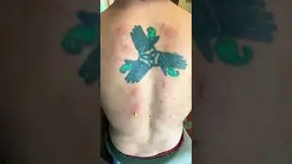 Bee venom therapy for my limes disease.#LymeDisease #BVenomTherapy.