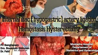Technique de ligature des artères hypogastriques +Hystérectomie d'hémostase/ Hemostasis hysterectomy