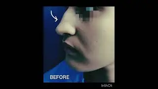 NOSE LIQUID RHINOPLASTY WITH FILLERS RESULTS 😍👏👌🤩