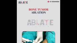 Osteoid osteoma treatment with ablation therapy