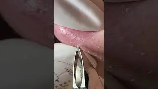NOSE ACNE - full clip of Mai Ngoc's Family members 