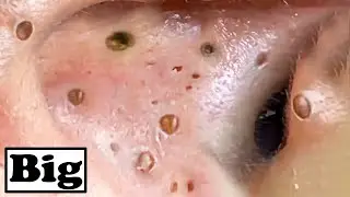 Super Removal Blackheads In Ear