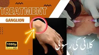 Wrist ganglion treatment | #wrists #shorts #treatment