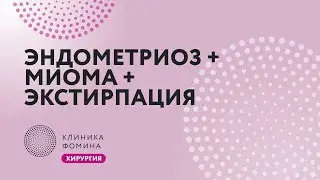 эндометриоз кишки + миома + экстирпация матки + киста яичника // глубокий эндометриоз лапароскопия