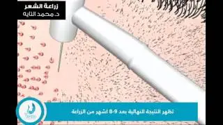زراعة الشعر بطريقة الاقتطاف (FUE)  الدكتور محمد تايه