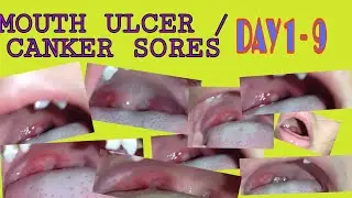 mouth ulcer or canker sore TIMELINE | day 1 to 9