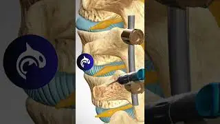 See how a Lumbar Fusion of the Spine works in 3D animation 