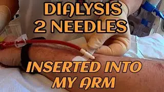 Dialysis: Preparation before hemodialysis where the scab is gently removed before fistula needle
