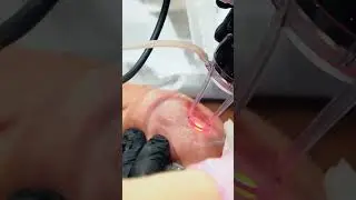 Acne Scar Treatment with TCA Cross, Subcision, and CO2 Lasers #acnescars