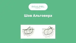Шов Альговера  \ Algover seam