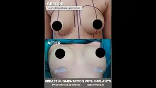 Breasts Augmentation with Implants 