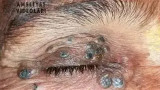 Yıllarca bekleyen Siyah noktalar Dev Sivilceler ! Böylesini görmediniz ! Blackhead