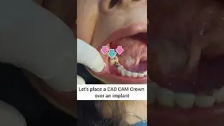 Placing a CAD CAM Crown over a dental implant: Dr. Srishti Bhatia #cadcam #implant #smile