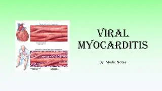 Viral myocarditis - causes, Lake Louise criteria, clinical features, investigations, treatment