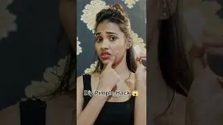 DIY Pimple Hack 😱 l Quick fix of your pimple #hack #diy #shorts #sonalimakeover #pimplesolution