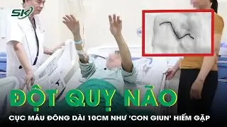 Hy hữu: Đột quỵ não do cục máu đông dài 10 cm như 'con giun' | SKĐS