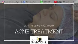 ACNE TREATMENT WITH PEELS -SALICYLIC PEEL/ GLYCOLIC PEEL TREATMENT FOR PIMPLES- DERMATOLOGIST REVIEW