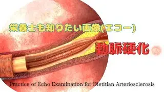 #113②【栄養士も知りたい画像(エコー)_動脈硬化】Practice of Echo Examination for Dietitian Arteriosclerosis