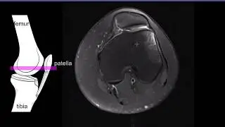 Patellar measurements
