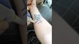 Сведение тату лазером