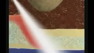 Daño tisular