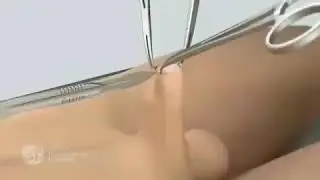 Circuncisión