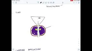 Prostatic Calculi