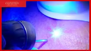 LASEmaR® mini 450 | teleangectasie volto - facial teleangectasias  [Eufoton®]