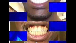 Dftv Teeth Whitening