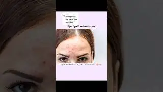 Forehead Acne Fix for Dry Skin | benzoyl peroxide ✨ #acnescars
