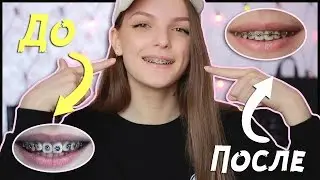 ВСЯ ПРАВДА О БРЕКЕТАХ