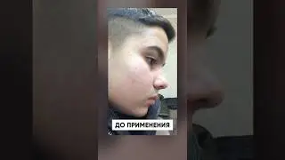 Борода с нуля за 5 месяцев / Результаты ксиноксина