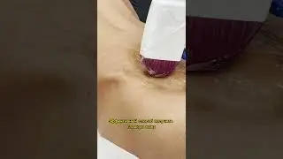 Лазерная эпиляция спины! Лазерная эпиляция Москва! Лучшей способ позаботиться о здоровье своей кожи