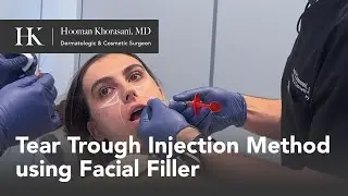 How to reduce dark spots under eye using dermal filler (Tear trough method) | Dr. Hooman Khorasani
