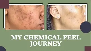Chemical Peel Journey | Hyperpigmentation on Black Skin | TCA Peel