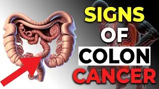 Colon Cancer After 50: DON'T IGNORE These Silent Warning Signs!