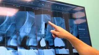 IMMEDIATE IMPLANT - DOTTOR VITTORIO MAGNANO