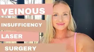 24 hours after Vein surgery!