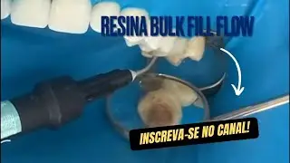 Uso da resina Bulk fill flow