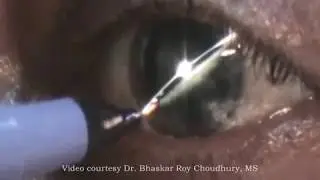 AccuMark BRC - The Sure & Easy Corneal Axis Markings for Toric IOLs