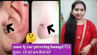 💞Nose & ear piercing bump(गाँट)सूजन, दर्द को कम🤔 कैसे करें💞