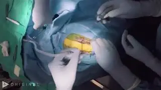 Endoscopic Third Ventriculostomy with Choroid Plexus Coagulation - Dr. Gerald Grant