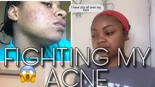 MY ACNE JOURNEY + PICTURES ! WHAT'S GETTING RID OF MY ACNE ! FT. DUVOLLE