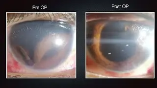 Fallen Beauty - Traumatic Iridodialysis Repair Surgery with Traumatic Cataract Management
