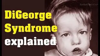 What is DiGeorge Syndrome - Cause and Treatment
