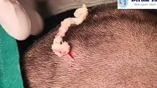 Sebaceous cyst on Scalp.