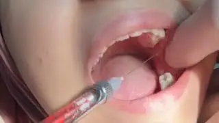 Inferior Alveolar Nerve block شرح  عربي مبسط